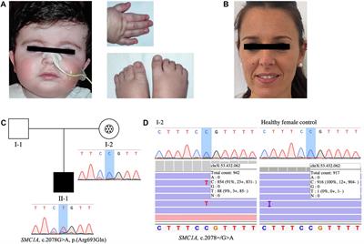 Frontiers Case Report A Novel Case Of Parental Mosaicism In Smc A